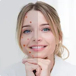 Remove Acne from Face | Indus Appstore | App Icon