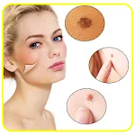 Skin Moles, Remédies to Remove | Indus Appstore | App Icon