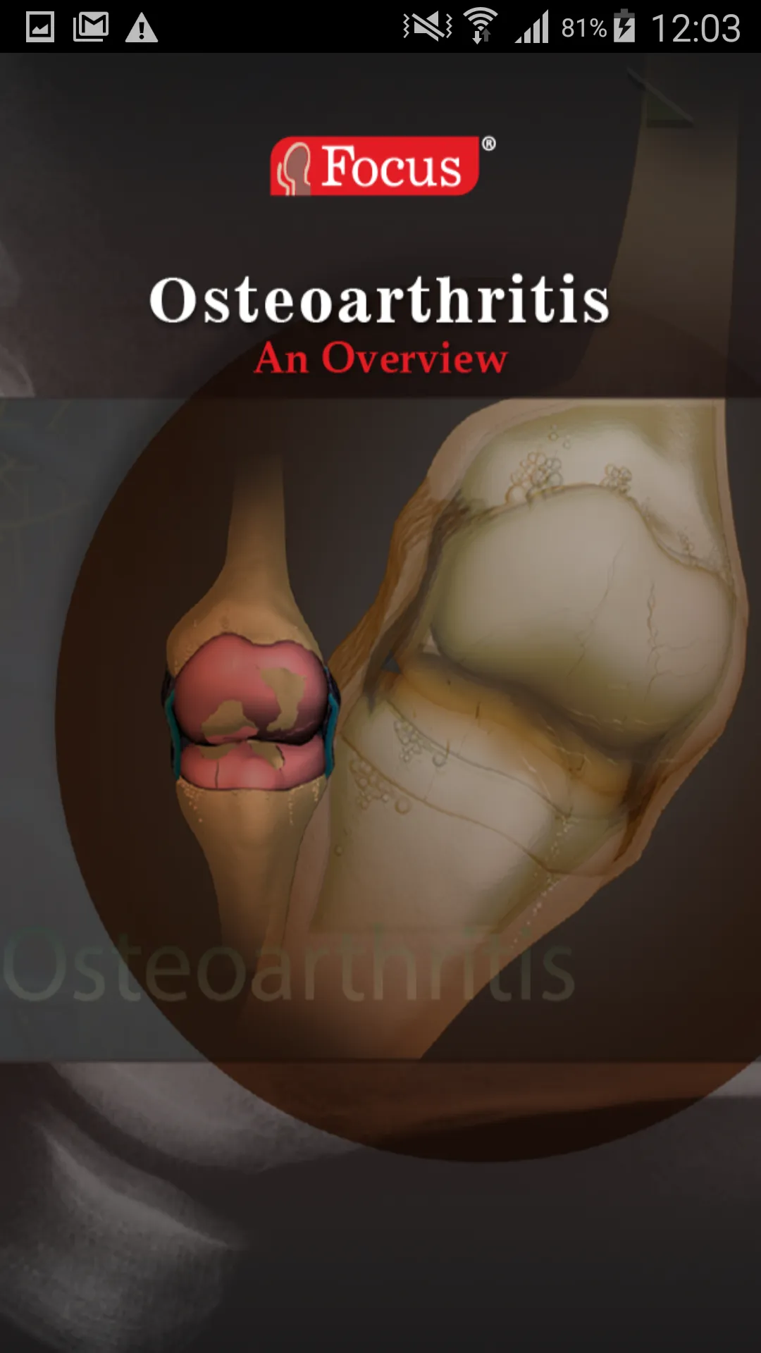 Osteoarthritis | Indus Appstore | Screenshot