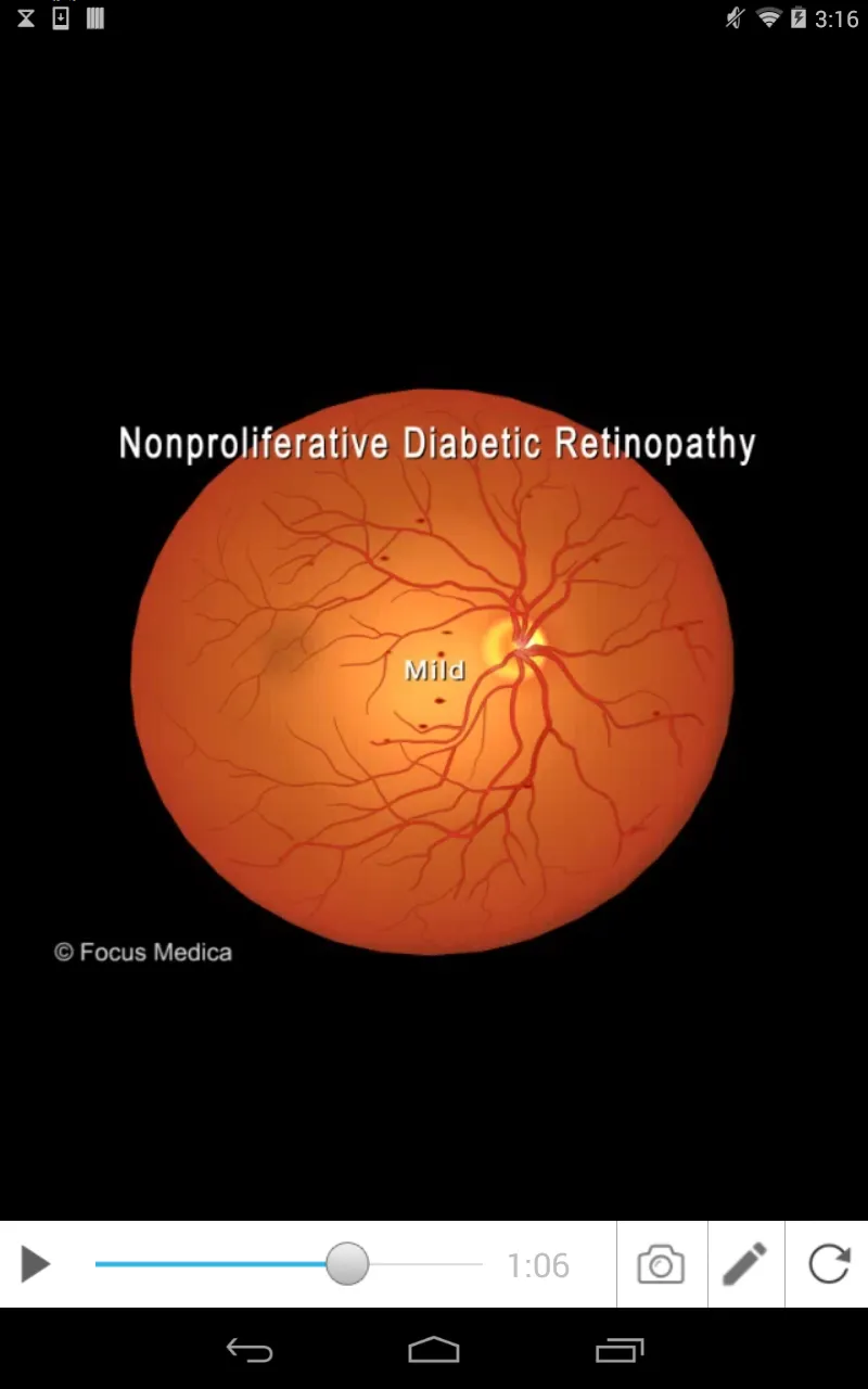 Diabetic Retinopathy | Indus Appstore | Screenshot