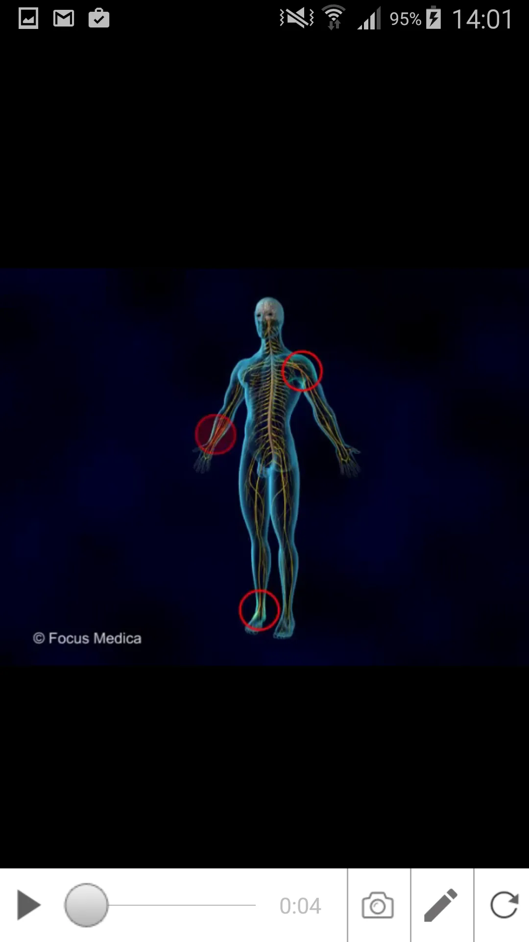 Neuropathic Pain | Indus Appstore | Screenshot