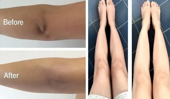 How to Get Rid Of Dark Knees A | Indus Appstore | Screenshot