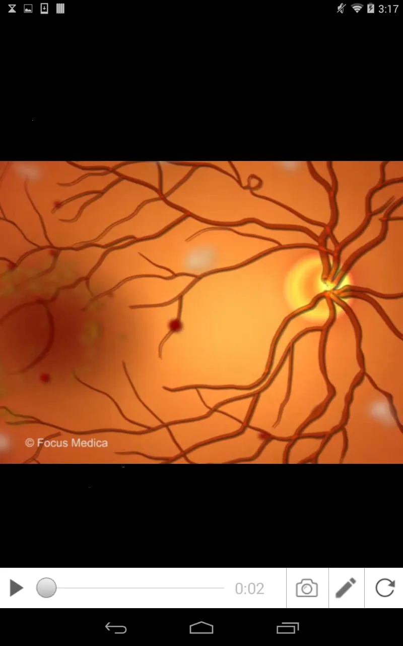 Diabetic Retinopathy | Indus Appstore | Screenshot