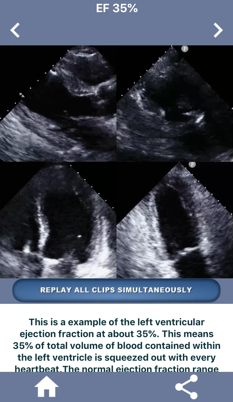 HEART EJECTION FRACTION | Indus Appstore | Screenshot