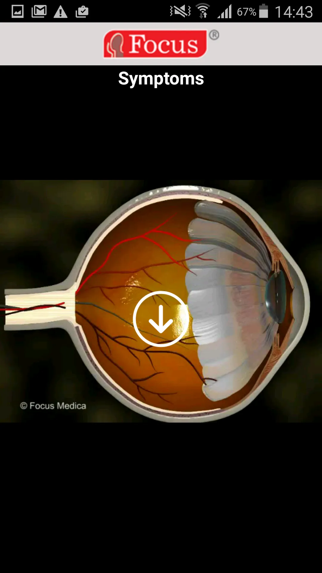 Glaucoma (An Overview) | Indus Appstore | Screenshot