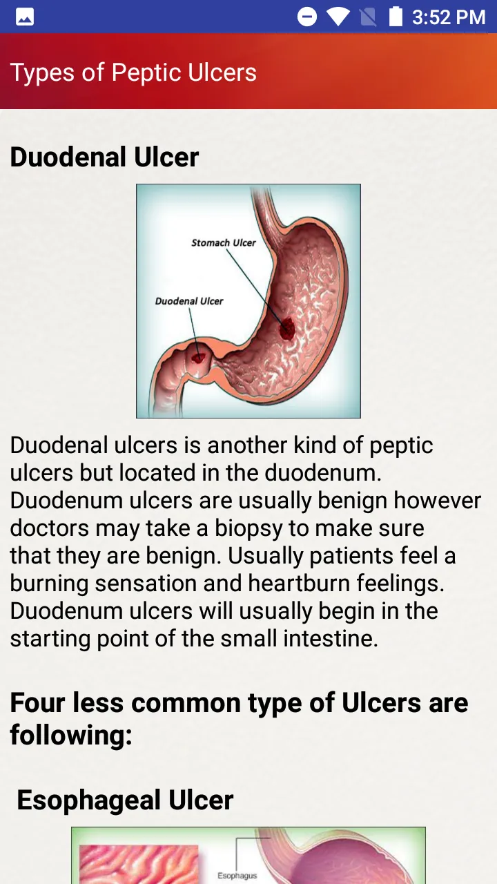 Peptic Ulcers Help & Diet Tips | Indus Appstore | Screenshot