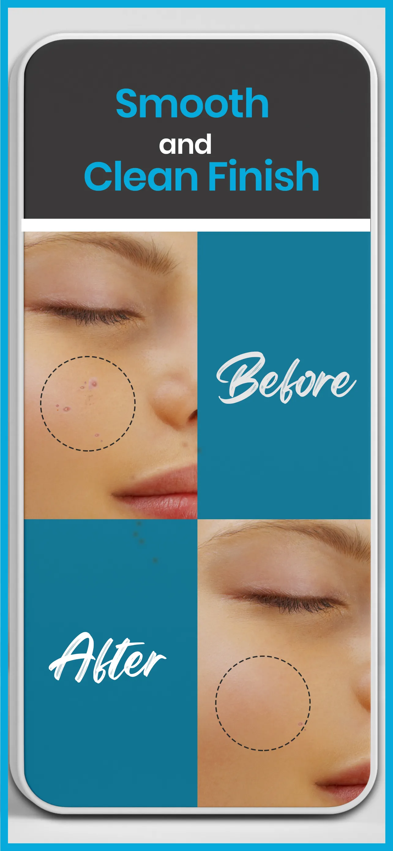 Pimple remover - Acne eraser | Indus Appstore | Screenshot