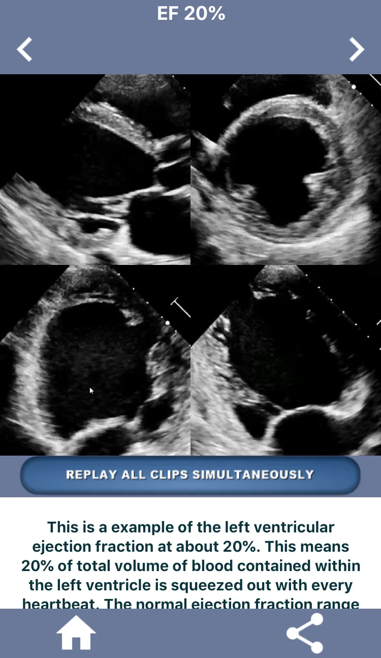 HEART EJECTION FRACTION | Indus Appstore | Screenshot