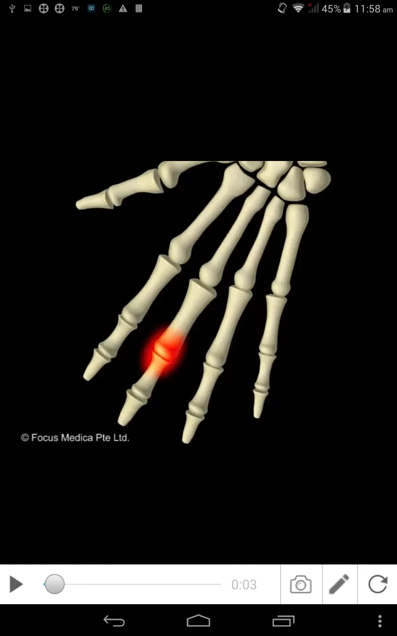 Osteoarthritis | Indus Appstore | Screenshot