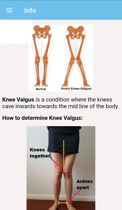 Knock Knees Exercises | Indus Appstore | Screenshot