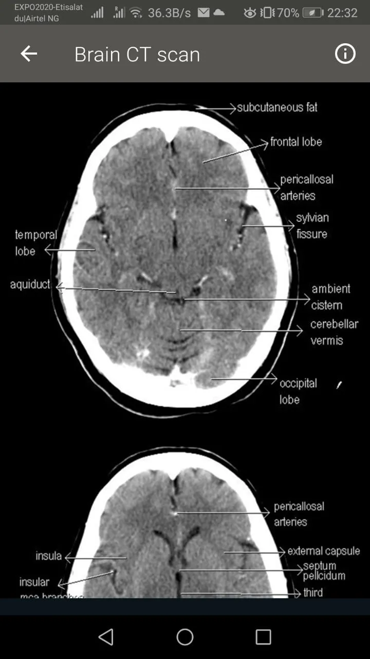 CT Scan of Brain | Indus Appstore | Screenshot