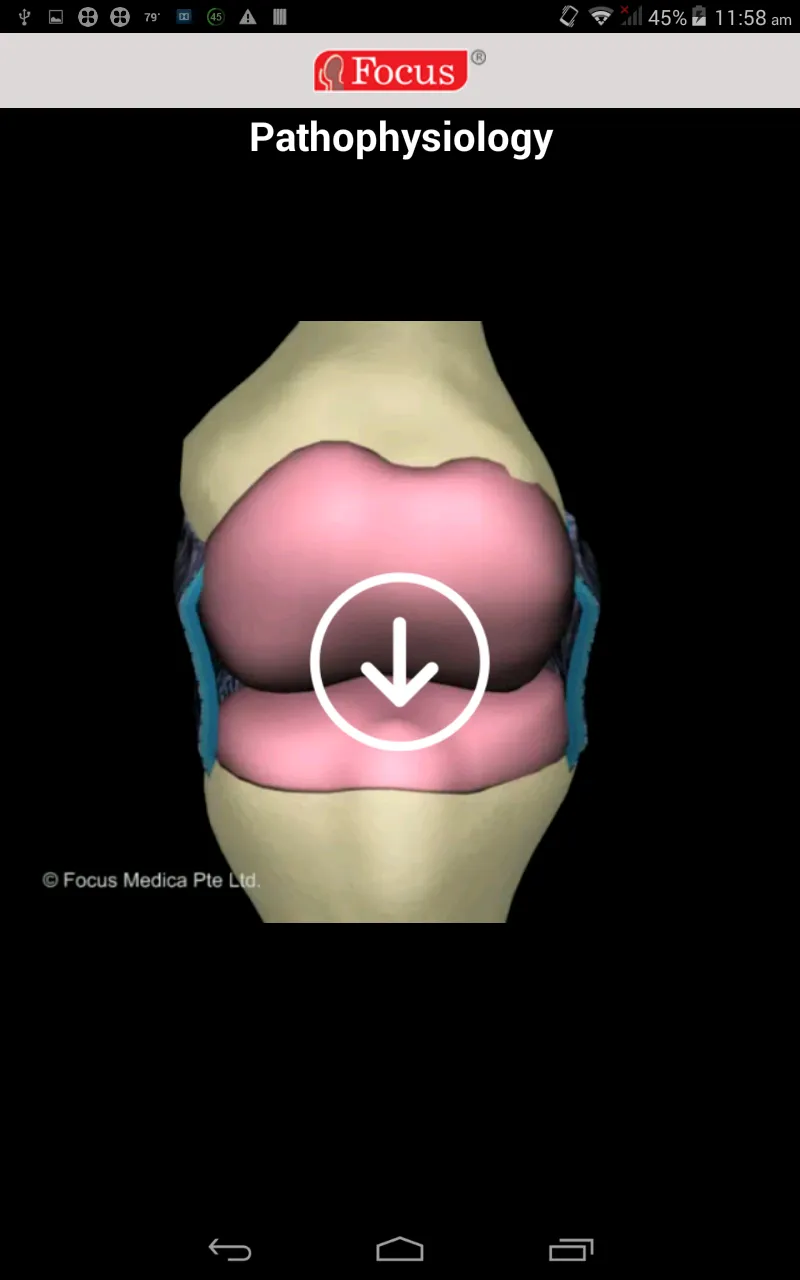 Osteoarthritis | Indus Appstore | Screenshot