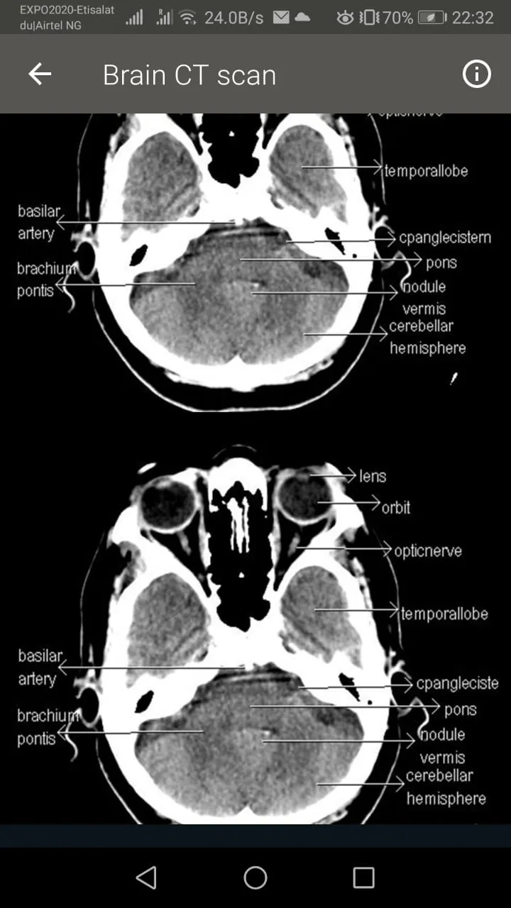 CT Scan of Brain | Indus Appstore | Screenshot
