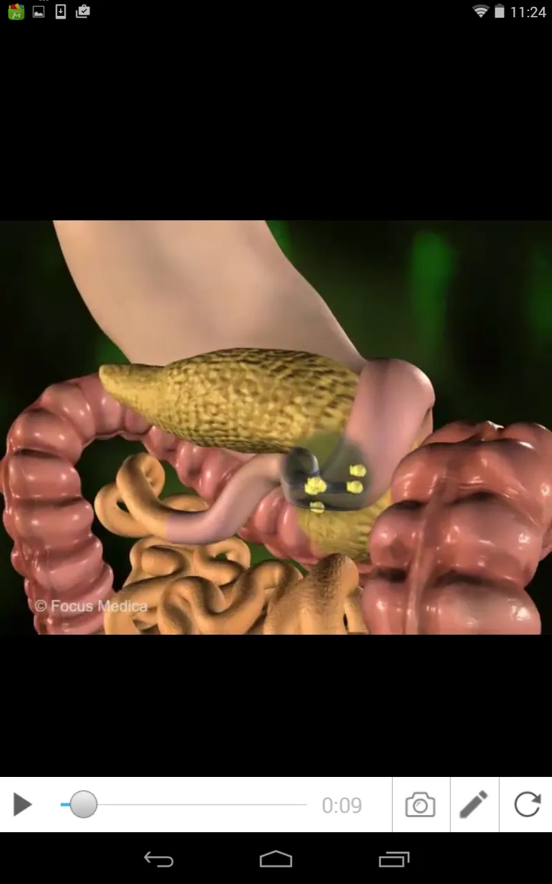 Inflammatory Bowel Disease | Indus Appstore | Screenshot