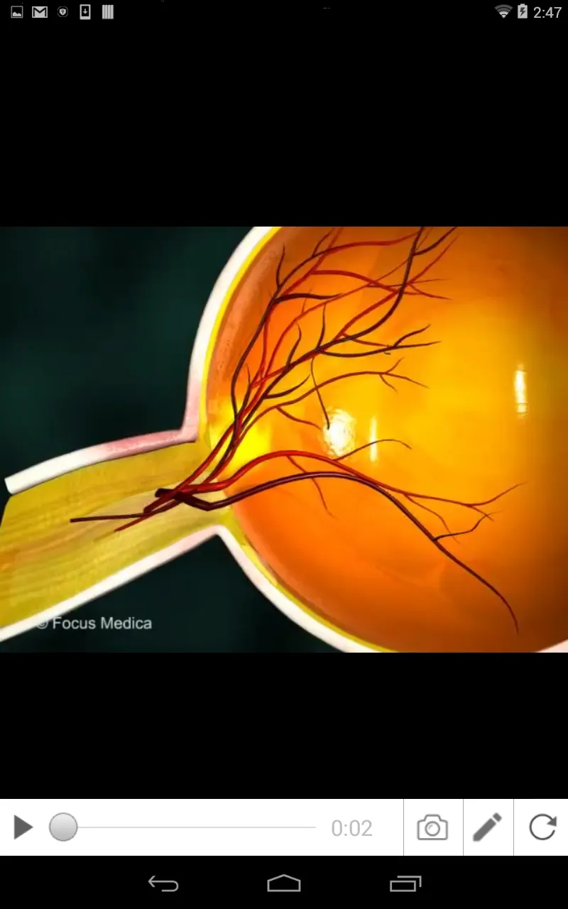 Glaucoma (An Overview) | Indus Appstore | Screenshot